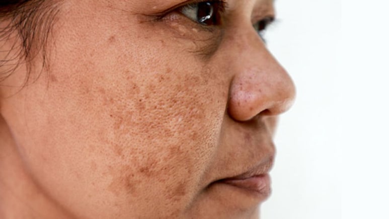 Pigmentation किसकी कमी से होता है? झाइयों को दूर करने के लिए कौन सा विटामिन अच्छा है?