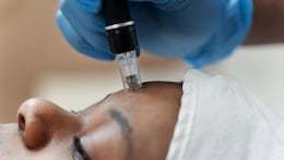 5 Things To Keep In Mind Before Opting For A Facial Hair Removal Treatment