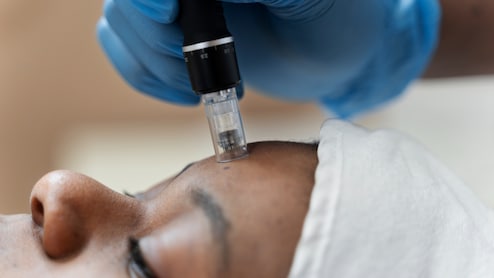 Microneedling By An Untrained Hand Can Leave More Than Scars, See Risks Invoved