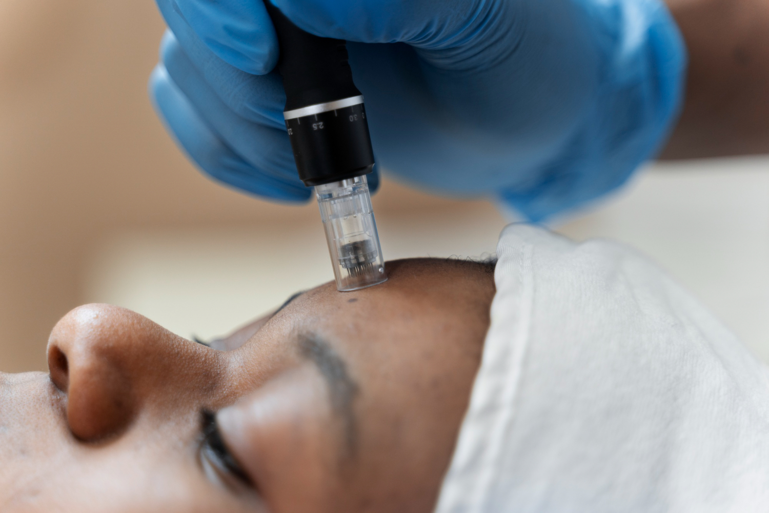 Microneedling By An Untrained Hand Can Leave More Than Scars, See Risks Invoved