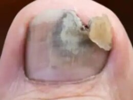 काले पड़ने और सड़ने लगे हैं नाखून, जानिए 15 दिन में ठीक करने का असरदार उपाय काले पड़ने और सड़ने लगे हैं नाखून, जानिए 15 दिन में ठीक करने का असरदार उपाय