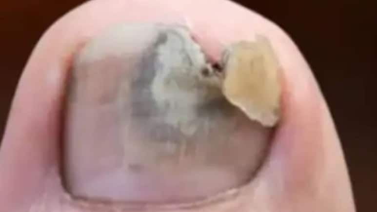 काले पड़ने और सड़ने लगे हैं नाखून, जानिए 15 दिन में ठीक करने का असरदार उपाय काले पड़ने और सड़ने लगे हैं नाखून, जानिए 15 दिन में ठीक करने का असरदार उपाय