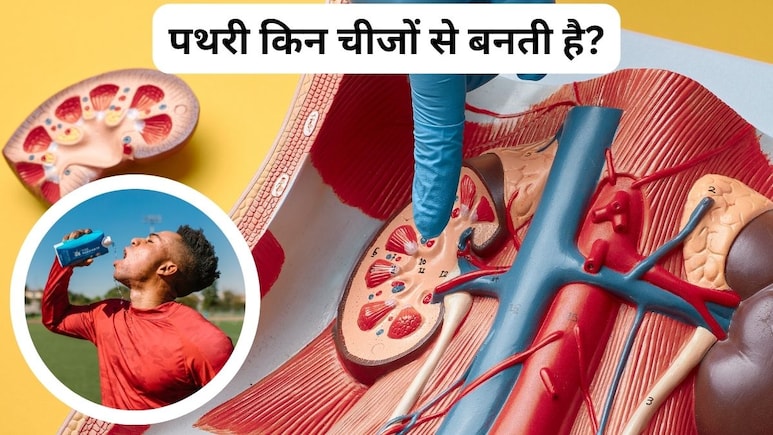 क्या पीने से किडनी में पथरी होती है? क्या पीने से किडनी में पथरी होती है?