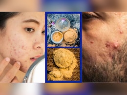 चेहरे पर मुल्तानी मिट्टी थोप लेने से मुंहासों से नहीं मिलेगा छुटकारा, डॉक्टर की सुन लें नहीं तो पड़ेगा पछताना चेहरे पर मुल्तानी मिट्टी थोप लेने से मुंहासों से नहीं मिलेगा छुटकारा, डॉक्टर की सुन लें नहीं तो पड़ेगा पछताना