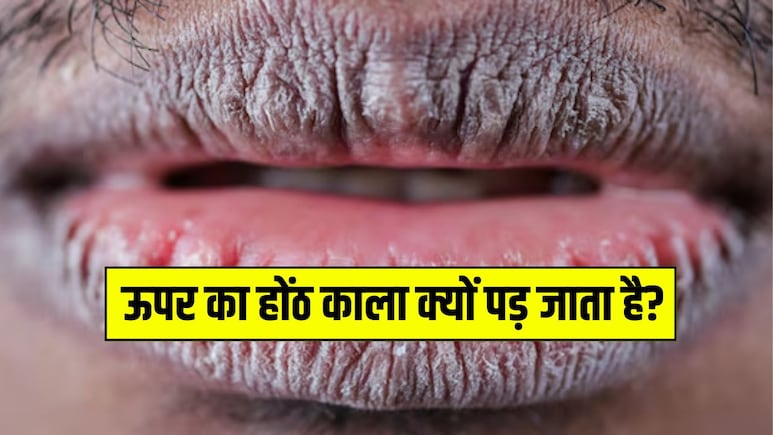 ऊपर का होंठ काला क्यों पड़ जाता है? डॉक्टर से जानें होंठों का कालापन दूर करने के लिए क्या करें