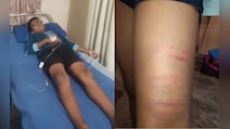 Bengaluru Boy, 9, In Hospital After School Principal Thrashes Him With Pipe