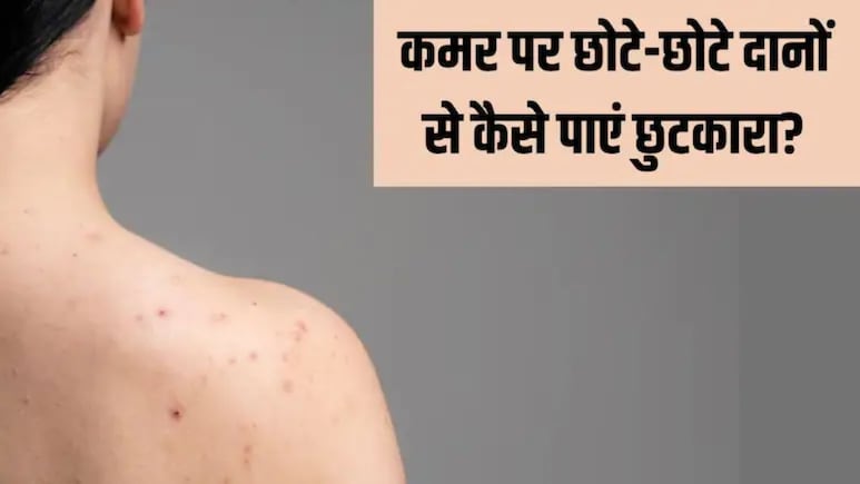 पीठ पर छोटी-छोटी फुंसी क्यों होती हैं? डॉक्टर से जानें कैसे पाएं Back Acne से छुटकारा पीठ पर छोटी-छोटी फुंसी क्यों होती हैं? डॉक्टर से जानें कैसे पाएं Back Acne से छुटकारा