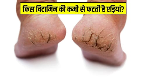 किस विटामिन की कमी से फटती हैं एड़ियां? डॉक्टर ने बताए एड़ियों के फटने के 5 बड़े कारण