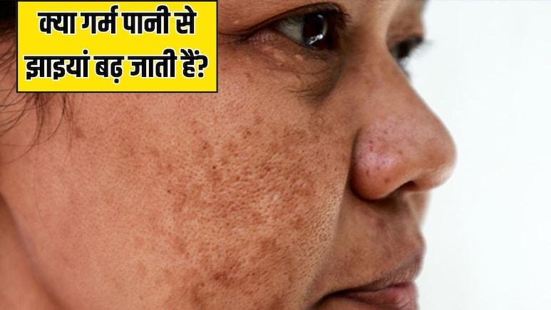 क्या गर्म पानी में नहाने से झाइयां बढ़ जाती हैं? स्किन की डॉक्टर ने बताया कैसा होगा चेहरे पर असर