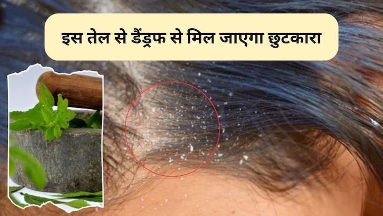 Dandruff And Hair Tips: डैंड्रफ से हैं परेशान तो इस जादुई तेल को लगाने से समस्या हो जाएगी दूर, बालों की ग्रोथ भी होगी जल्दी Dandruff And Hair Tips: डैंड्रफ से हैं परेशान तो इस जादुई तेल को लगाने से समस्या हो जाएगी दूर, बालों की ग्रोथ भी होगी जल्दी