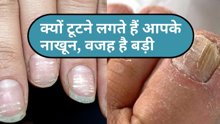 कमजोर और टूटते नाखूनों को न करें इग्नोर, ये हैं शरीर की अंदरूनी बीमारी का बड़ा संकेत कमजोर और टूटते नाखूनों को न करें इग्नोर, ये हैं शरीर की अंदरूनी बीमारी का बड़ा संकेत