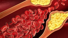 Can Diet Alone Help Improve Cholesterol Levels? Expert Answers