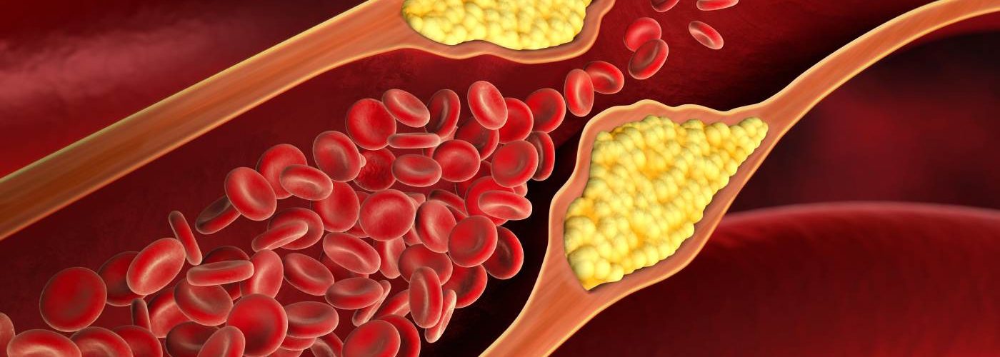 New Research On Gene Editing Therapy May Cut Cholesterol, Triglycerides By Half