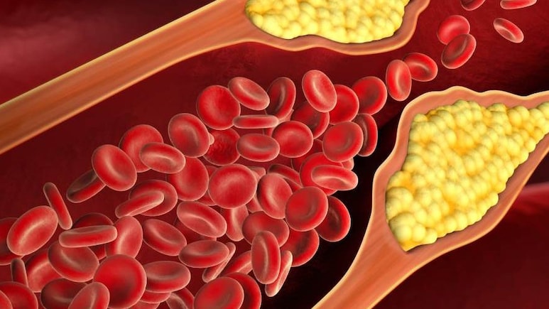 कोलेस्ट्रॉल को गोली की स्पीड से बढ़ाती हैं आपकी ये गलतियां, काबू पाने के लिए सुबह कच्ची खाएं ये एक चीज कोलेस्ट्रॉल को गोली की स्पीड से बढ़ाती हैं आपकी ये गलतियां, काबू पाने के लिए सुबह कच्ची खाएं ये एक चीज