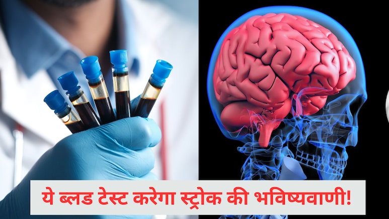 ब्लड टेस्ट जो करता है स्ट्रोक की भविष्यवाणी, इस संकेत को पहचान लगा सकते हैं Stroke का पता