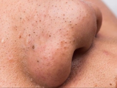 Tired Of Blackheads? These Natural Fixes Might Be All You Need