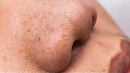 Tired Of Blackheads? These Natural Fixes Might Be All You Need