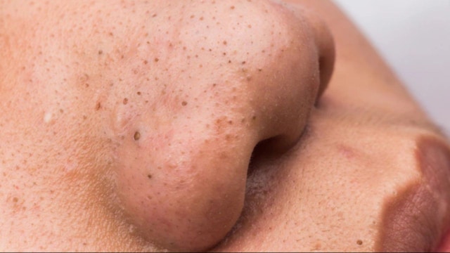 blackheads remain open at the surface of the skin