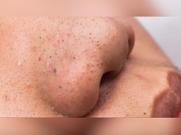 5 मिनट में नाक के ब्लैकहेड्स हटाने के घरेलू नुस्खे | Naak Se Blackhead Kaise Hataye 5 मिनट में नाक के ब्लैकहेड्स हटाने के घरेलू नुस्खे | Naak Se Blackhead Kaise Hataye