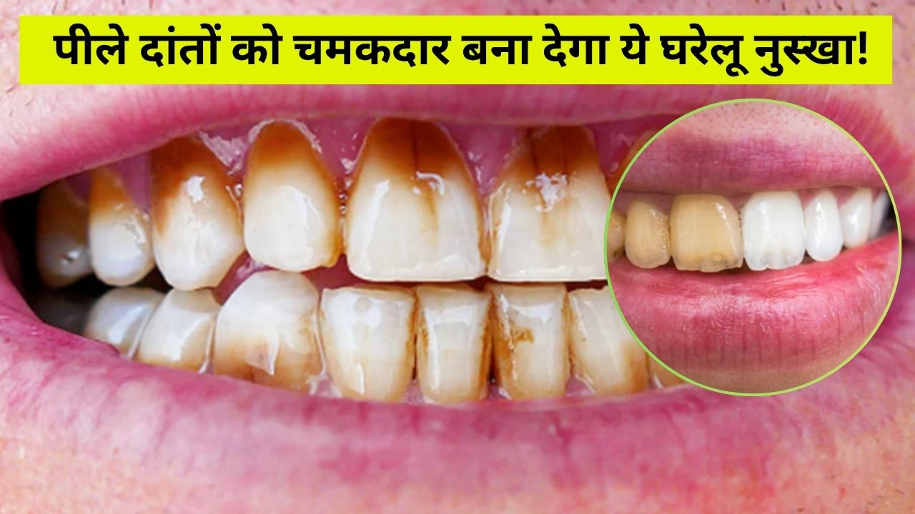 पीले दांतों को मोतियों सा चमकदार बना देंगी रसोई में मौजूद ये चीजें...