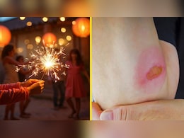 Home Remedies for Crackers Burn: दिवाली पर पटाखों से जल गए हाथ-पैर? अपनाएं ये असरदार घरेलू उपाय, मिलेगी राहत Home Remedies for Crackers Burn: दिवाली पर पटाखों से जल गए हाथ-पैर? अपनाएं ये असरदार घरेलू उपाय, मिलेगी राहत