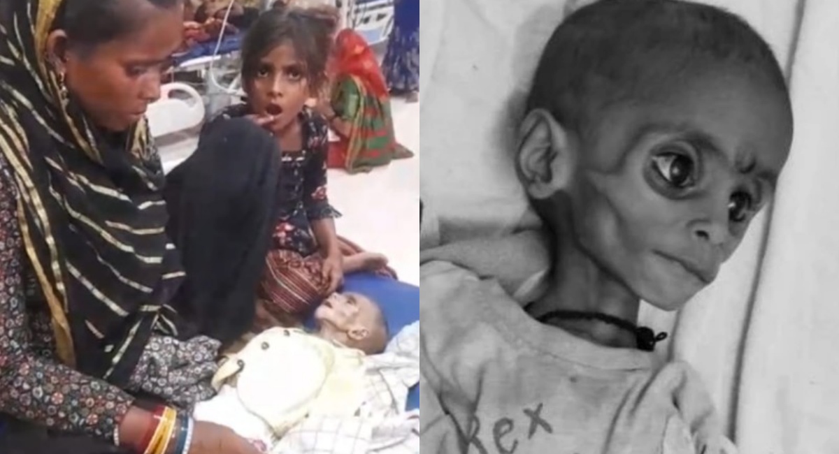सूखे बच्चे, 10 लाख भूखे, सिस्टम चुप, MP के इन तीन जिलों की चुप्पी कोई सुनेगा?