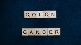 Study Finds Two Common Colon Polyps That Can Raise Colon Cancer Risk Fivefold