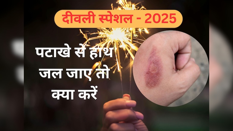 Diwali 2025 : हल्का जलने पर इस तरह करें घर में इलाज, यहां जानें जलन कम करने और इन्फेक्शन रोकने के आसान टिप्स Diwali 2025 : हल्का जलने पर इस तरह करें घर में इलाज, यहां जानें जलन कम करने और इन्फेक्शन रोकने के आसान टिप्स