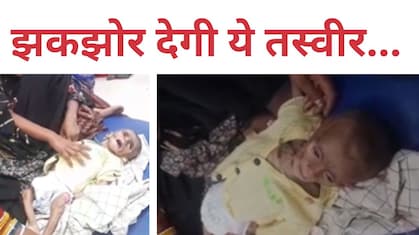 मासूम की हड्डियों से चिपक गई चमड़ी, कुपोषण की ऐसी मार कि रोने पर आवाज भी नहीं निकलती