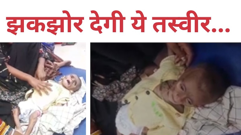 मासूम की हड्डियों से चिपक गई चमड़ी, कुपोषण की ऐसी मार कि रोने पर आवाज भी नहीं निकलती मासूम की हड्डियों से चिपक गई चमड़ी, कुपोषण की ऐसी मार कि रोने पर आवाज भी नहीं निकलती