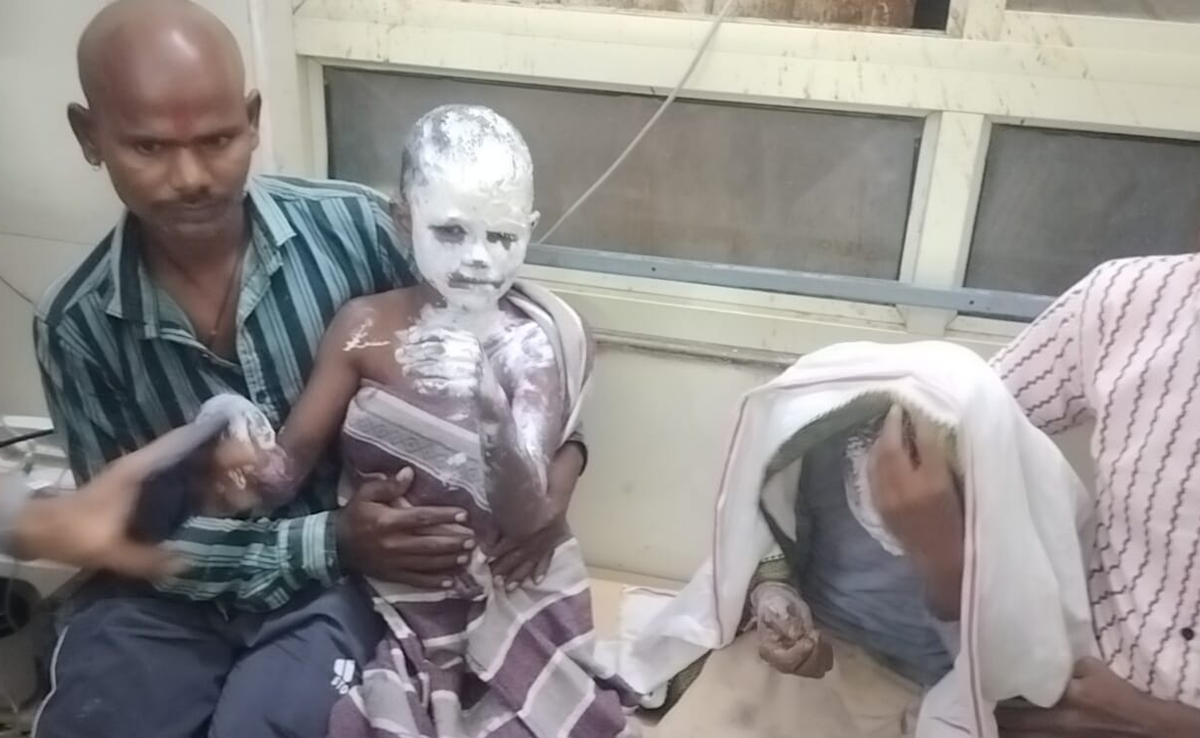 Firecracker Accident: मुरैना में पटाखों से हादसा, एक युवक व दो बच्चे गंभीर रूप से झुलसे Firecracker Accident: मुरैना में पटाखों से हादसा, एक युवक व दो बच्चे गंभीर रूप से झुलसे