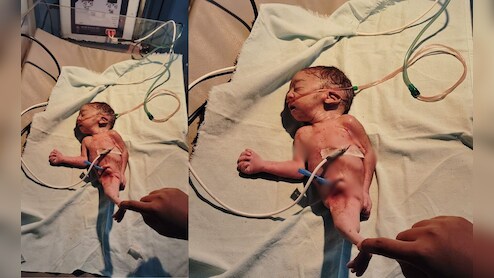 Jalpari Jaisa Baccha: छत्तीसगढ़ में जन्‍मा 'जलपरी' जैसा बच्‍चा, पैर देखकर डॉक्‍टर भी रह गए हैरान 