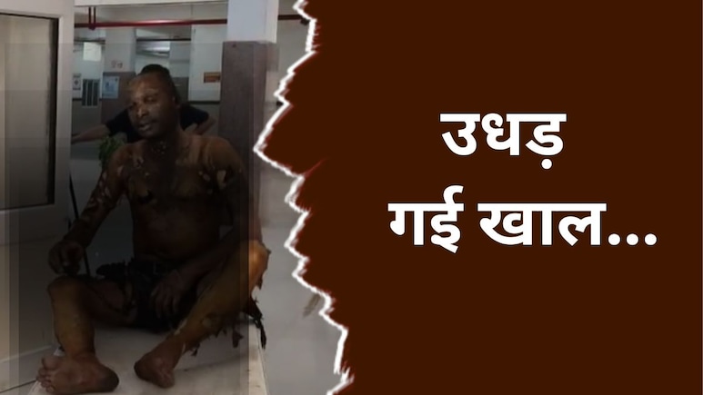 पारिवारिक विवाद में आत्मदाह का प्रयास, हालत गंभीर, भाई बोला- भाभी और दामाद ने पेट्रोल डालकर जलाया