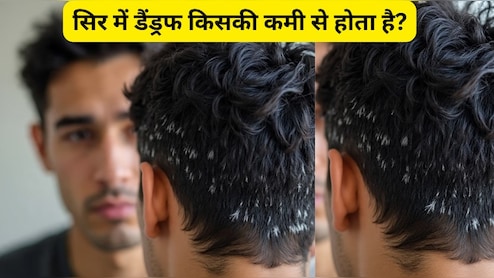 जड़ से डैंड्रफ कैसे खत्म करें? सिर में डैंड्रफ किसकी कमी से होता है? जानिए यहां पर