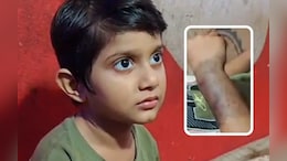 कुत्तों से सावधान! बच्ची के हाथ में रह गया स्ट्रीट डॉग का दांत, दो दिन में 11 लोगों को काटा&nbsp;