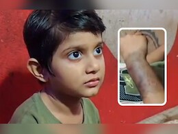 कुत्तों से सावधान! बच्ची के हाथ में रह गया स्ट्रीट डॉग का दांत, दो दिन में 11 लोगों को काटा 