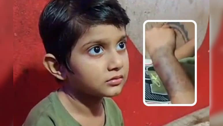 कुत्तों से सावधान! बच्ची के हाथ में रह गया स्ट्रीट डॉग का दांत, दो दिन में 11 लोगों को काटा 