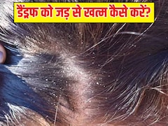 सर्दियों के मौसम में डैंड्रफ ने कर दिया है परेशान? डॉक्टर से जानें छुटकारा पाने के आसान उपाय
