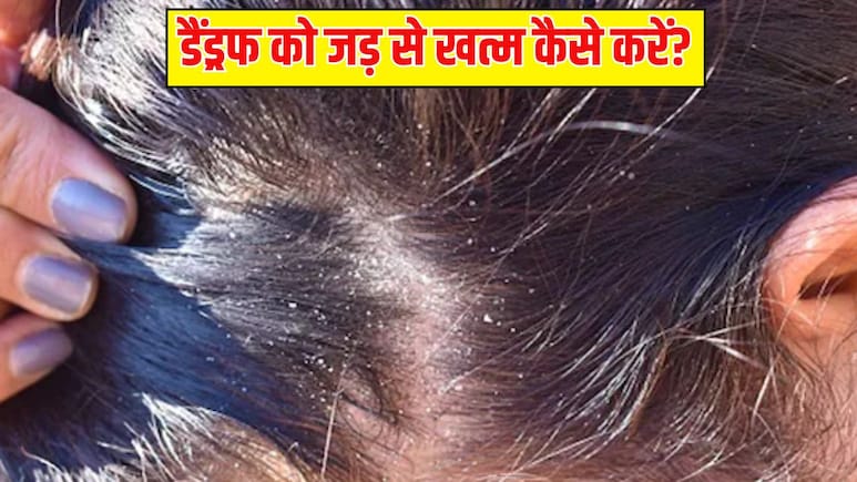सर्दियों के मौसम में डैंड्रफ ने कर दिया है परेशान? डॉक्टर से जानें छुटकारा पाने के आसान उपाय
