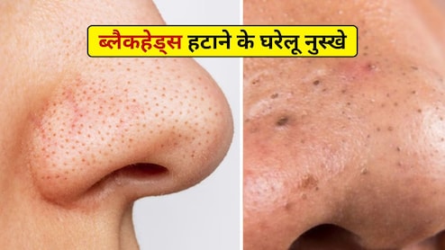 नाक पर जमे जिद्दी ब्लैकहेड्स कर रहे हैं खूबसूरती फीकी? आजमाएं ये आसान घरेलू नुस्खे, मिनटों में दूर हो जाएगी समस्या