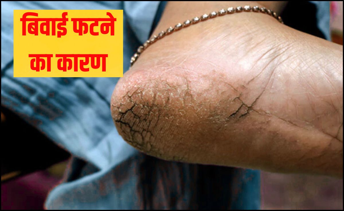किस विटामिन की कमी से एड़ी में दरार पड़ जाती है? बिवाई फटने का क्या कारण है, जान गए तो खुद कर लेंगे इलाज