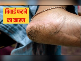 किस विटामिन की कमी से एड़ी में दरार पड़ जाती है? बिवाई फटने का क्या कारण है, जान गए तो खुद कर लेंगे इलाज
