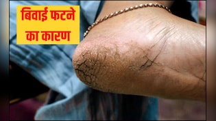 गर्मियों में फटती हैं एड़ियां, तो अपनाएं ये घरेलू उपाय, बनेंगे खूबसूरत और मुलायम