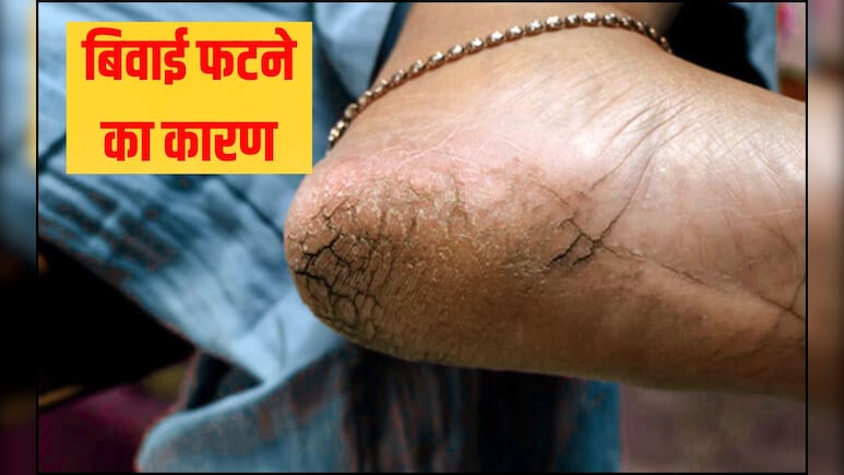 किस विटामिन की कमी से एड़ी में दरार पड़ जाती है? बिवाई फटने का क्या कारण है, जान गए तो खुद कर लेंगे इलाज