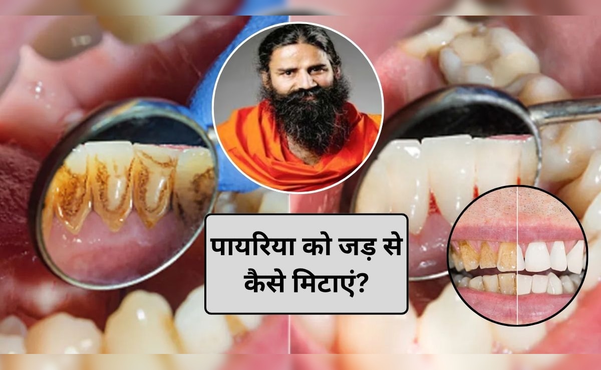 Teeth Care Tips: दांत दर्द और पायरिया का रामबाण इलाज है ये पौधा, बाबा रामदेव ने बताया कैसे करें इस्तेमाल