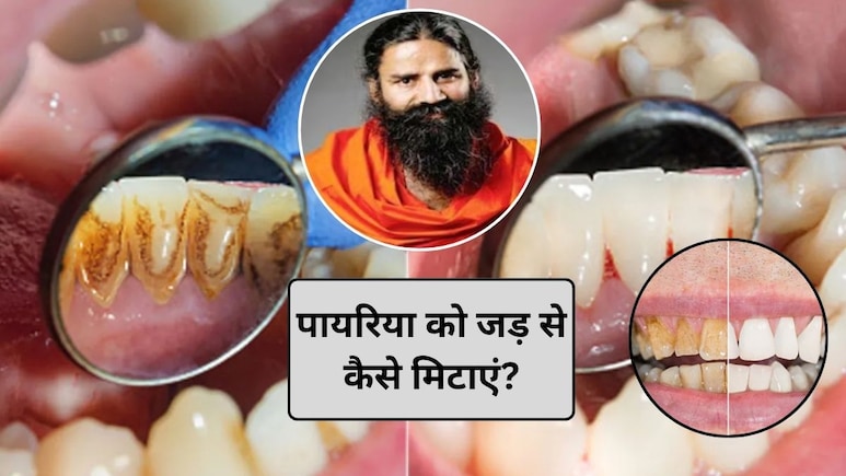 Teeth Care Tips: दांत दर्द और पायरिया का रामबाण इलाज है ये पौधा, बाबा रामदेव ने बताया कैसे करें इस्तेमाल