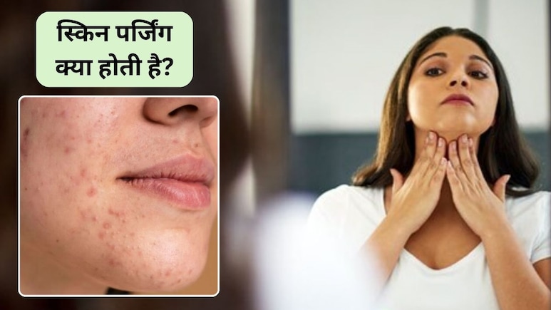 What is Skin Purging: चेहरे पर बार-बार फुंसी और दाने निकल रहे हैं? त्वचा खराब होने का संकेत या क्लियर स्किन शुरुआत? जानिए स्किन पर्जिंग क्या है