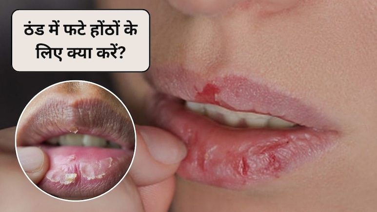 क्या आप ठंड के कारण फटे होंठों से परेशान हैं? रात में होंठों पर क्या लगाना चाहिए, डॉक्टर ने बताया 1 दिन में फटे होंठ ठीक करने का उपाय