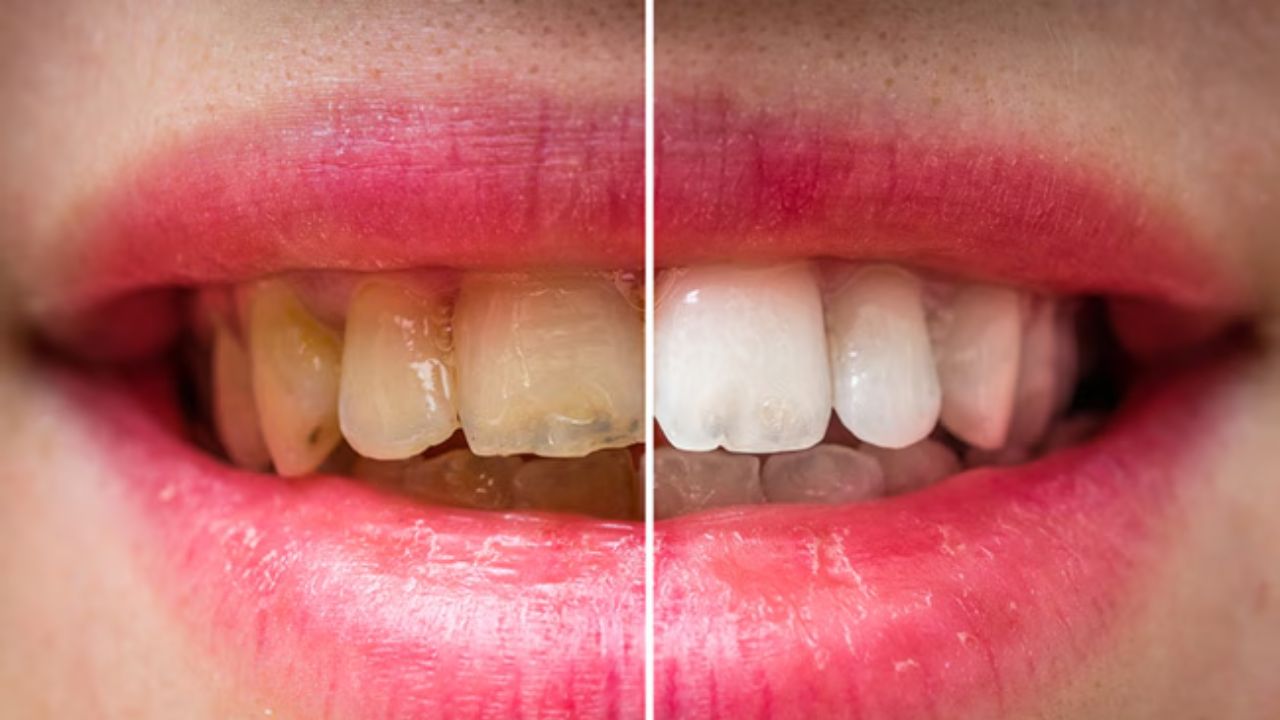 दांतों से पीली गंदगी कैसे निकालें? डॉक्टर ने बताया बेकिंग सोडा में क्या मिलाकर लगाने से दांतों का पीलापन साफ हो जाता है
