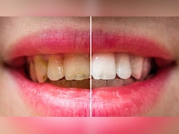 दांतों से पीली गंदगी कैसे निकालें? डॉक्टर ने बताया बेकिंग सोडा में क्या मिलाकर लगाने से दांतों का पीलापन साफ हो जाता है